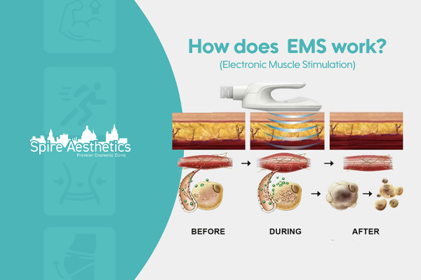 EMS treatment for post pregnancy weight loss treatment Springs Mire