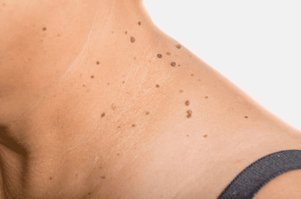 Are you looking for easy skin tag removal Springs Mire - then contact Spire today!
