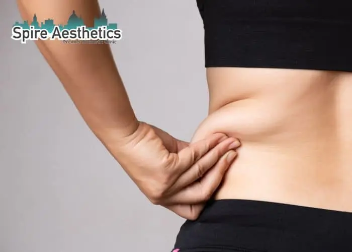 Image of woman pinching fat on their hips Springs Mire. Fat Freezing treatment