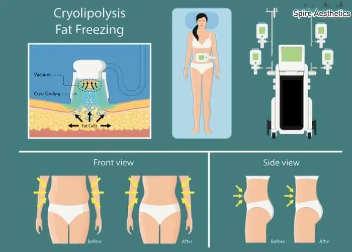 Fat freezing treatment Springs Mire benefits for competitions to remove stubborn fat deposits.