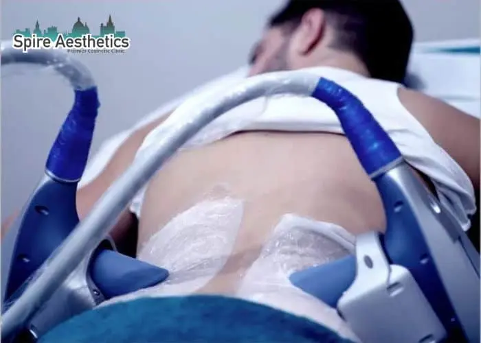 Man having fat freezing treatment done on love handles before a competitions Springs Mire to create a sculpted look.