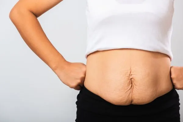 Image of a woman's stomach after weight loss with sagging skin following a gastric band Springs Mire
